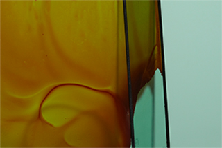 Le Syndrome de Bonnard